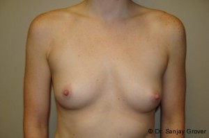 Breast Augmentation Before and After 279 | Sanjay Grover MD FACS