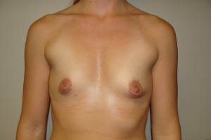 Breast Augmentation Before and After 254 | Sanjay Grover MD FACS