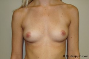 Breast Augmentation Before and After 132 | Sanjay Grover MD FACS
