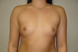 Breast Augmentation Before and After 23 | Sanjay Grover MD FACS