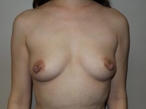 Breast Augmentation Before and After 13 | Sanjay Grover MD FACS