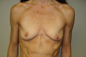Breast Augmentation Before and After 118 | Sanjay Grover MD FACS
