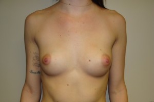 Breast Augmentation Before and After 146 | Sanjay Grover MD FACS