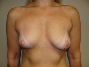 Breast Augmentation Before and After 203 | Sanjay Grover MD FACS