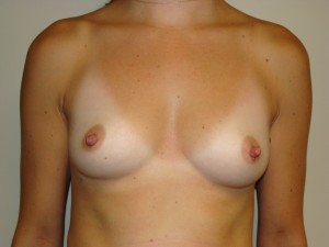 Breast Augmentation Before and After 129 | Sanjay Grover MD FACS