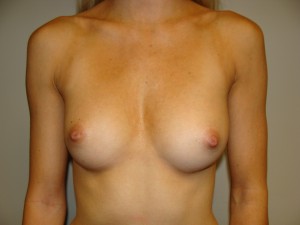 Breast Augmentation Before and After 193 | Sanjay Grover MD FACS