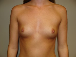 Breast Augmentation Before and After 157 | Sanjay Grover MD FACS