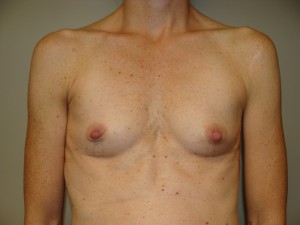 Breast Augmentation Before and After 09 | Sanjay Grover MD FACS
