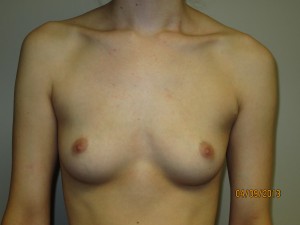 Breast Augmentation Before and After 213 | Sanjay Grover MD FACS