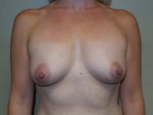 Breast Augmentation Before and After 50 | Sanjay Grover MD FACS
