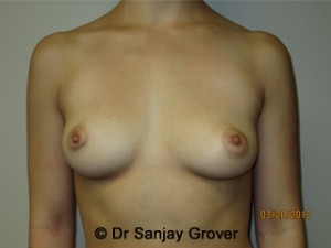 Breast Augmentation Before and After 259 | Sanjay Grover MD FACS