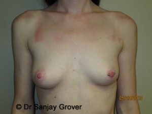 Breast Augmentation Before and After 283 | Sanjay Grover MD FACS
