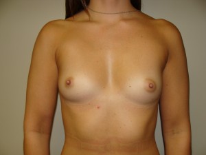 Breast Augmentation Before and After 52 | Sanjay Grover MD FACS