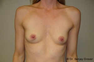 Breast Augmentation Before and After 192 | Sanjay Grover MD FACS
