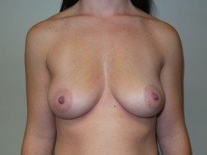 Breast Augmentation Before and After 296 | Sanjay Grover MD FACS