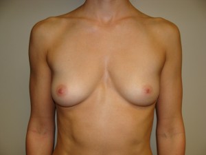 Breast Augmentation Before and After 296 | Sanjay Grover MD FACS