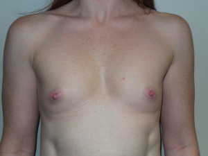 Breast Augmentation Before and After 193 | Sanjay Grover MD FACS