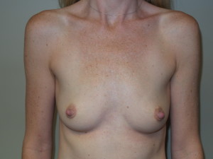 Breast Augmentation Before and After 120 | Sanjay Grover MD FACS
