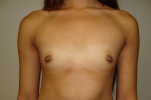 Breast Augmentation Before and After 180 | Sanjay Grover MD FACS