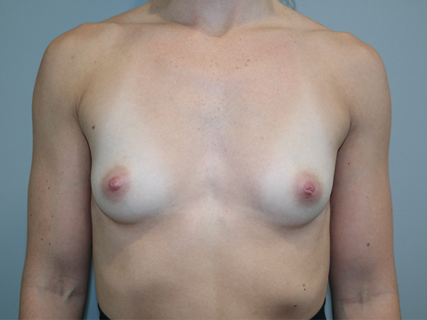 Breast Augmentation Before and After 259 | Sanjay Grover MD FACS