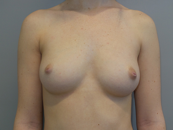 Breast Augmentation Before and After 179 | Sanjay Grover MD FACS