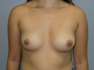 Breast Augmentation Before and After 262 | Sanjay Grover MD FACS