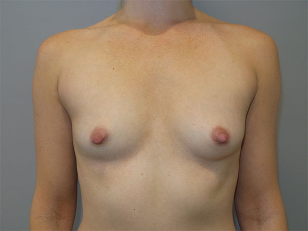 Breast Augmentation Before and After 201 | Sanjay Grover MD FACS
