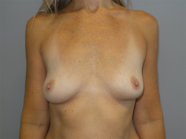 Breast Augmentation Before and After 293 | Sanjay Grover MD FACS