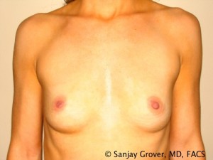 Breast Augmentation Before and After 262 | Sanjay Grover MD FACS