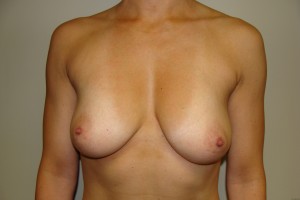Breast Augmentation Before and After 248 | Sanjay Grover MD FACS
