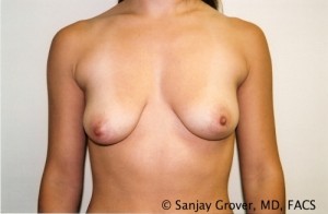 Breast Augmentation Before and After 04 | Sanjay Grover MD FACS