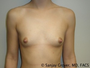 Breast Augmentation Before and After 133 | Sanjay Grover MD FACS