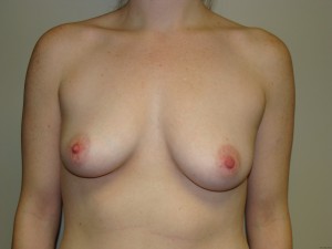 Breast Augmentation Before and After 02 | Sanjay Grover MD FACS