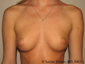 Breast Augmentation Before and After 174 | Sanjay Grover MD FACS