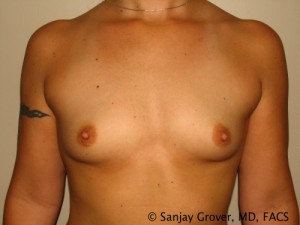 Breast Augmentation Before and After 05 | Sanjay Grover MD FACS