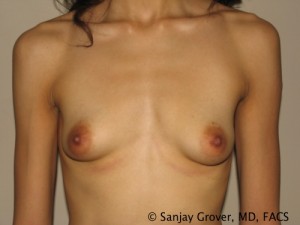 Breast Augmentation Before and After 166 | Sanjay Grover MD FACS