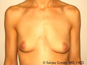 Breast Augmentation Before and After 125 | Sanjay Grover MD FACS