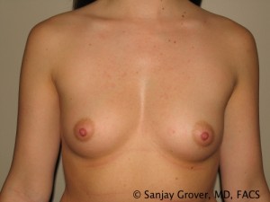 Breast Augmentation Before and After 228 | Sanjay Grover MD FACS
