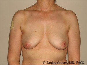 Breast Augmentation Before and After 37 | Sanjay Grover MD FACS