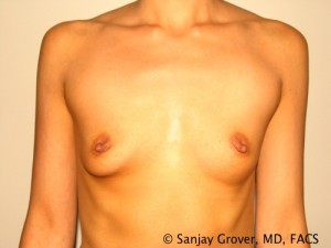 Breast Augmentation Before and After 266 | Sanjay Grover MD FACS