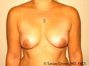 Breast Augmentation Before and After 137 | Sanjay Grover MD FACS