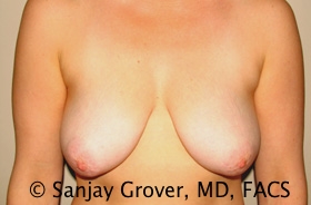Breast Lift Before and After 42 | Sanjay Grover MD FACS