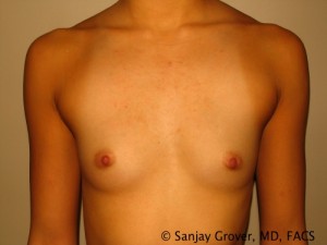 Mini Breast Augmentation Before and After 06 | Sanjay Grover MD FACS