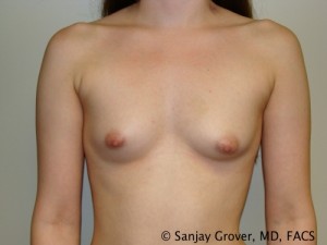 Mini Breast Augmentation Before and After 08 | Sanjay Grover MD FACS