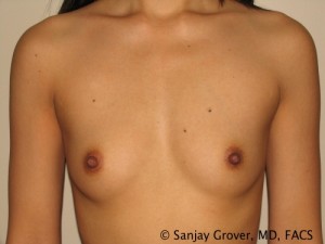 Mini Breast Augmentation Before and After 06 | Sanjay Grover MD FACS