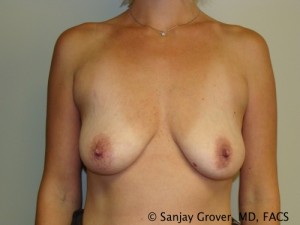 Mini Breast Lift Before and After 14 | Sanjay Grover MD FACS