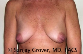 Mini Breast Lift Before and After 08 | Sanjay Grover MD FACS