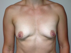 Mini Breast Lift Before and After 12 | Sanjay Grover MD FACS