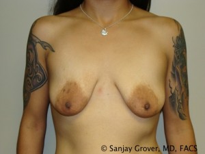 Mini Breast Lift Before and After 25 | Sanjay Grover MD FACS