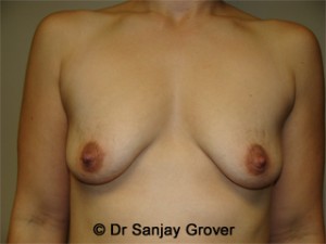 Mini Breast Lift Before and After 08 | Sanjay Grover MD FACS
